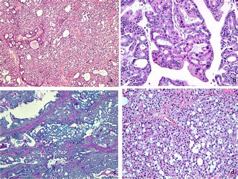 Axillary Node Metastasis From Differentiated Thyroid Carcinoma With