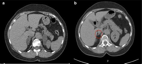 Adrenal Ct Of Patient With Symmetric Bilateral Hyperplasia A