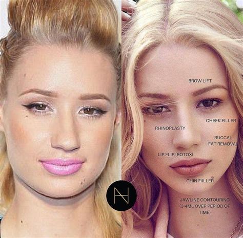 Pin By Ivy Star On Plastic Surgery Face Plastic Surgery Facial Fillers Face Fillers