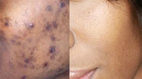 Video How To Get Rid Of Dark Spots Acne Scars