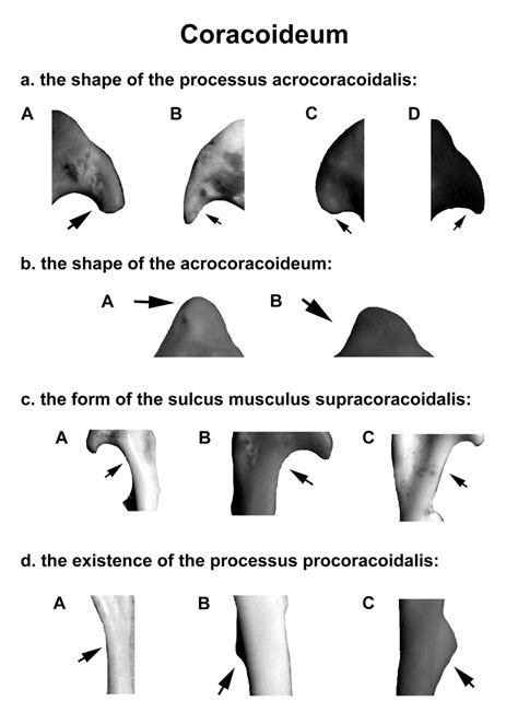 Coracoideum Coding Sample A The Shape Of The Processus Download