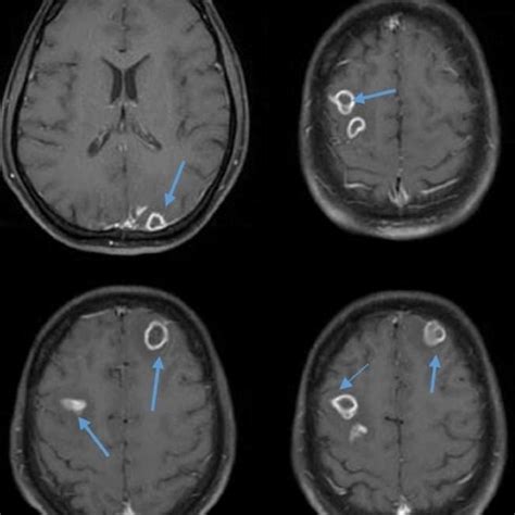 Axial Images Of The Brain Mri Showing A Ring Enhancing Lesion In The