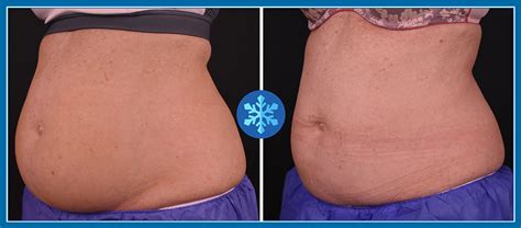 However, rents are still reasonable compared to other major cities. CoolSculpting Atlanta | 30% OFF Fat Freezing | $400 Gift ...