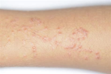 Allergic Reaction To Henna Tattoo Photograph By Dr P Marazziscience