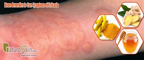 10 Effective And Best Home Remedies For Urticaria