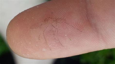 Amazing Picture Shows Final Moment Of Mosquito Imprinted On Finger Of