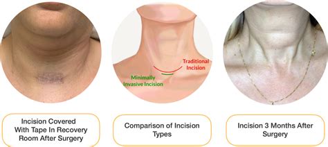 Minimally Invasive Thyroidectomy Larian MD