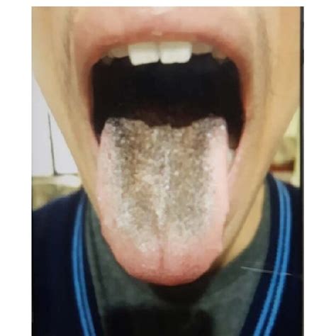 Linezolid Associated Black Hairy Tongue After One Month Of Treatment Download Scientific