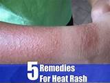 Photos of What Is The Best Treatment For Heat Rash