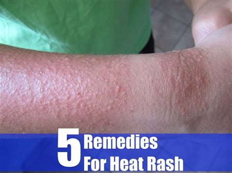 Prickly heat, heat rash, whatever you want to call it, it's annoying! 5 Remedies For Heat Rash | Good to know | Pinterest | Heat ...