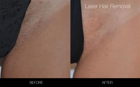 danach Großzügigkeit Agitation brazilian laser hair removal before and