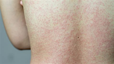 What Happens To Your Body When You Have Shingles