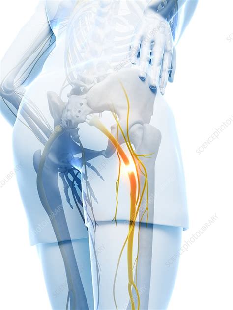 Painful Sciatic Nerve Artwork Stock Image F0077240 Science
