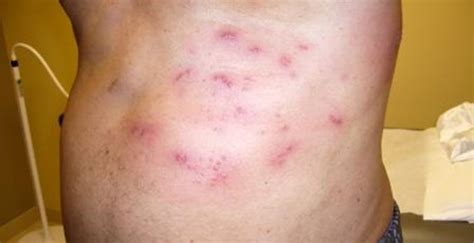 Type 2 Diabetic Male Experiencing Painful Rash Journal Of Urgent Care