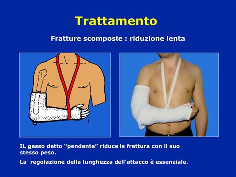 PPT - Fratture dell'estremo superiore dell'omero ...
