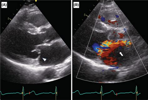 Transthoracic Echocardiography Tte Parasternal Long‐axis View A