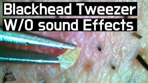 Wo Sound Effects Ver Pull Out Blackheads Whiteheads Close Up 300x