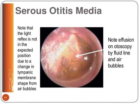 Image Result For Om With Effusion Otitis Media Otitis Positivity