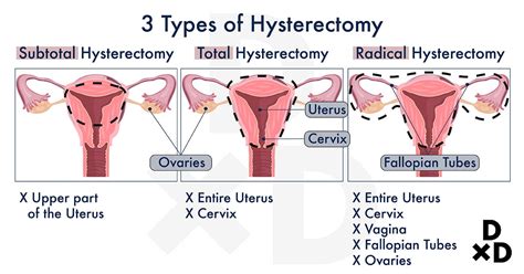 The Ultimate Guide To Hysterectomy In Singapore Human