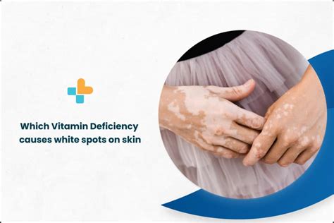 Which Vitamin Deficiency Causes White Spots On Skin Ayu Health
