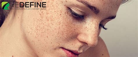 Laser Treatment For Freckles Cost In India Laser Treatment In Hyderabad