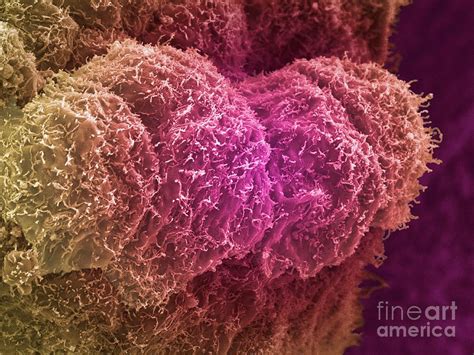 Prostate Cancer Cells Photograph By Anne Weston Francis Crick