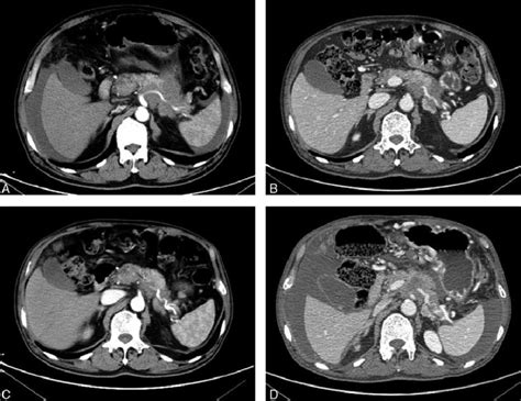 Abdominal Ct Scans Before And After Apatinib Therapy A Ct Scans