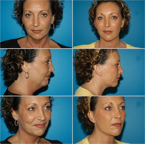 Before And After Plastic Surgery Neck Lift Naples Plastic Surgery