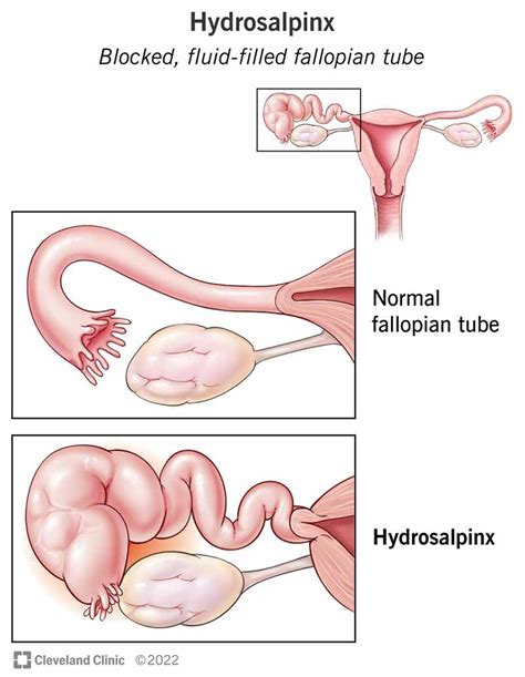 Fallopian Tube On Ultrasound Hot Sex Picture