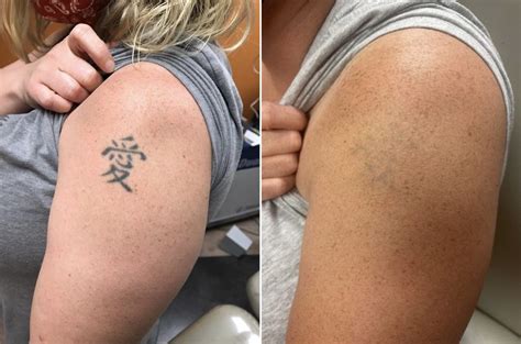 Tattoo Removal Archives Puremd