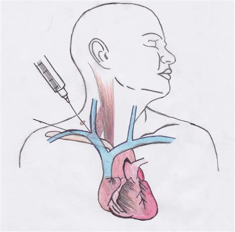 subclavian vein central venous access anesthesia key