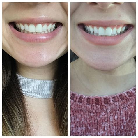 Pin On Teeth Whitening Before And After