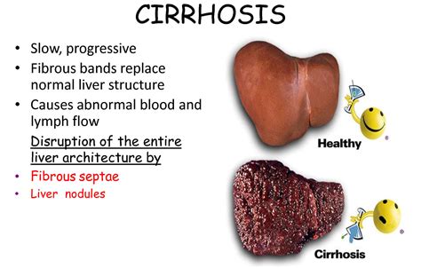 What You Need To Know About Cirrhosis Protecting And Treatment Health And Love Page