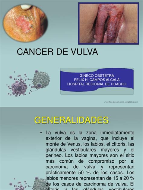 Cancer Vulvar 2018 Metástasis Cáncer