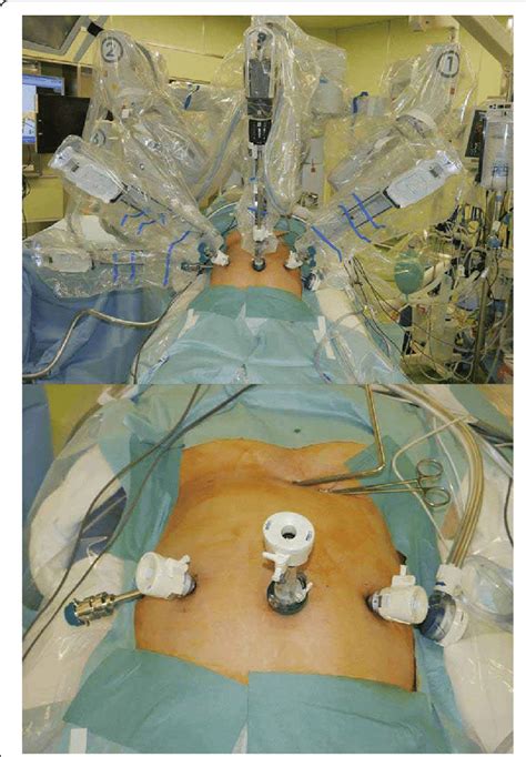 Placement Of Trocars And Robotic Arms Photographs Showing The Surgical