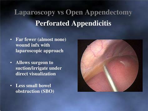 Ppt Appendicitis Challenges In Management Powerpoint Presentation