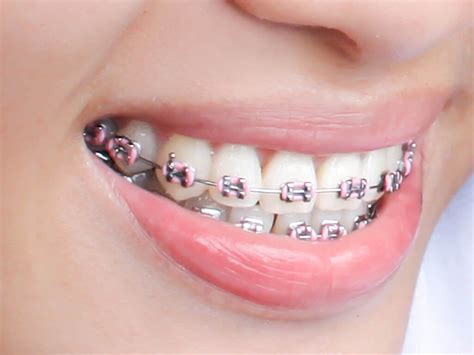 What Is Malocclusion Classes And Correction Options