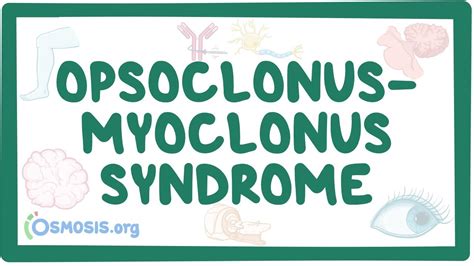 Opsoclonus Myoclonus Syndrome Nord Video And Anatomy Osmosis
