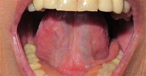 Dermapixel Leucoplasia Algo Más Que Una Manchita En La Boca