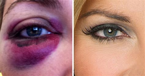 Crazy Reactions To My Black Eye—commentary
