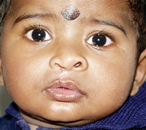Treatment For Cleft Lip And Palate Cleft Lip Surgeon In India