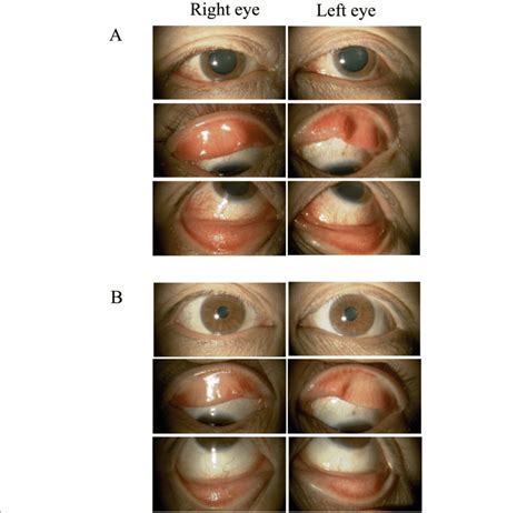 Clinical Findings Of Bilateral Blepharitis And Conjunctivitis After