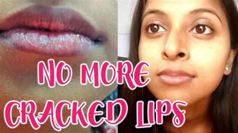 How To Get Rid Of Dry Lips Instantly Youtube