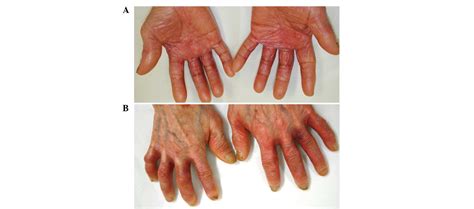 Treatment Of Capecitabine‑induced Hand‑foot Syndrome Using A Topical
