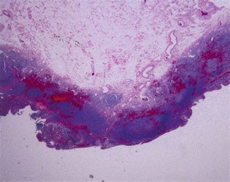 Nodular Lymphoid Hyperplasia A Cause For Obscure Massive
