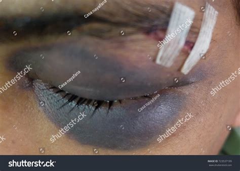 3件の「Head injury racoon eyes」の画像、写真素材、ベクター画像 | Shutterstock