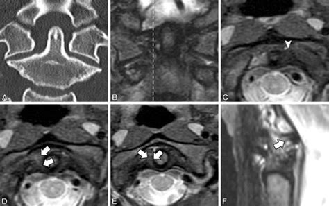 Diagnostic Benefit Of Mri For Exclusion Of Ligamentous Injury In