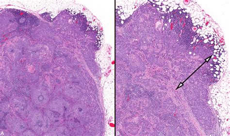 A Low Power Image Of A Lymph Node Containing Metastatic Squamous Cell