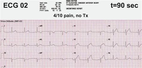 Dr Smiths Ecg Blog Incredible Case Demonstrating The