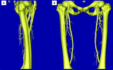The 3d Reconstruction Model Of Femur And Femoral Arteries A Lateral